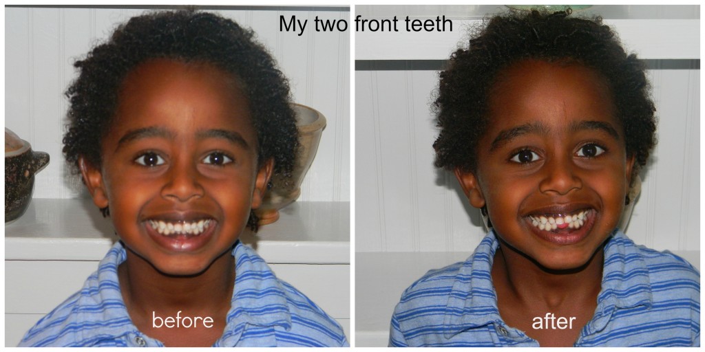 My Two Front Teeth